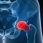 Caso 2: Disfunção coxo-femoral